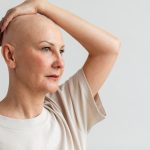 autoimun alopecia